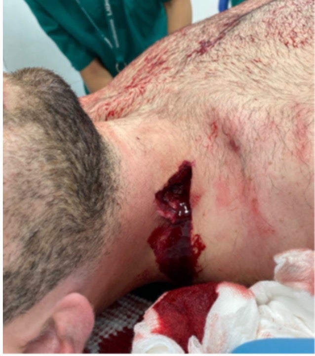 مقذوفة ذات تأثير متحرك أصابت متظاهرة في الرقبة.