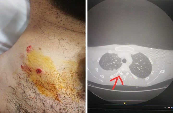 A metal pellet pierced through a protester’s neck, tore an artery, punctured the lung, and lodged in the spinal cord. 