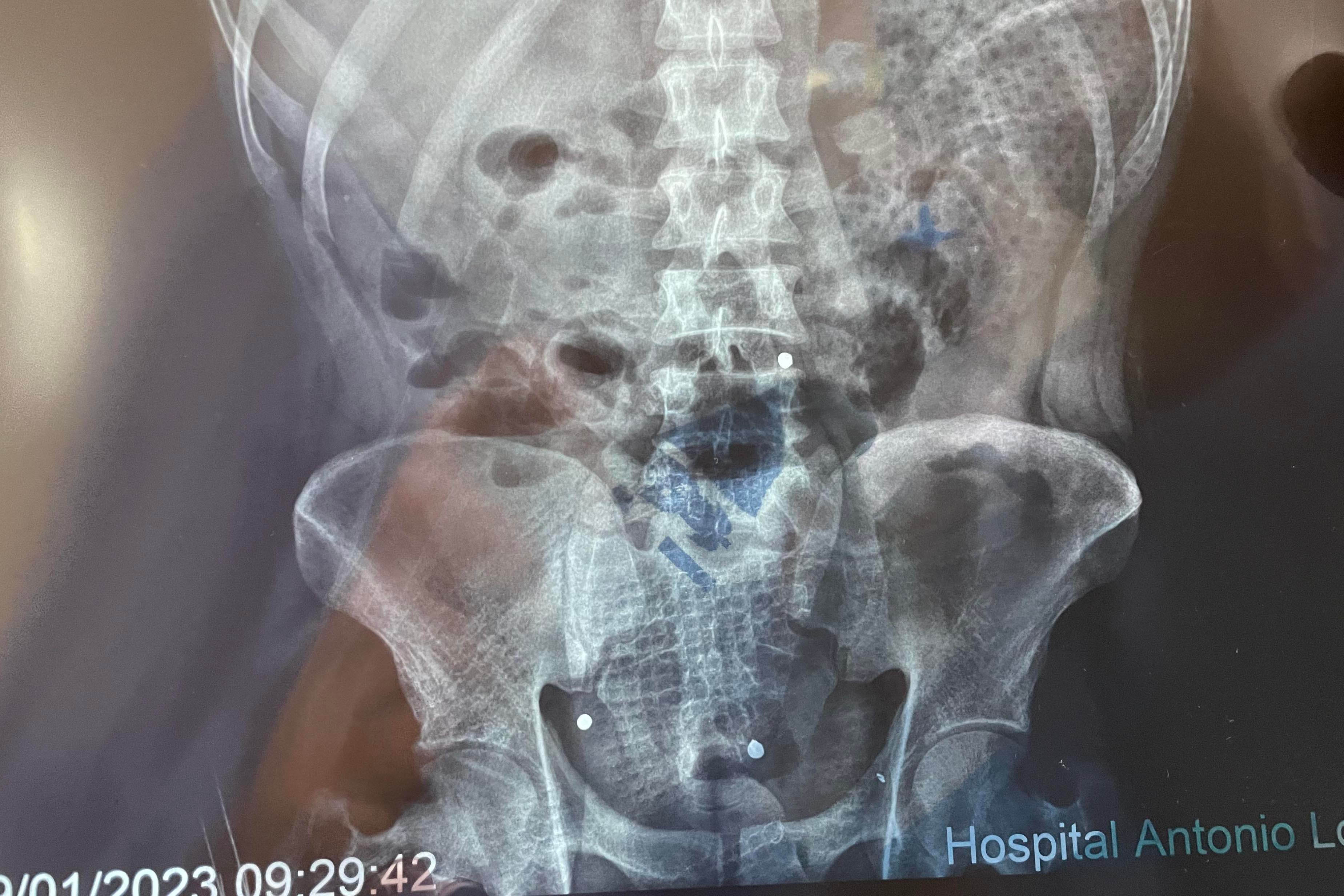 202304americas_peru_edgar_xray