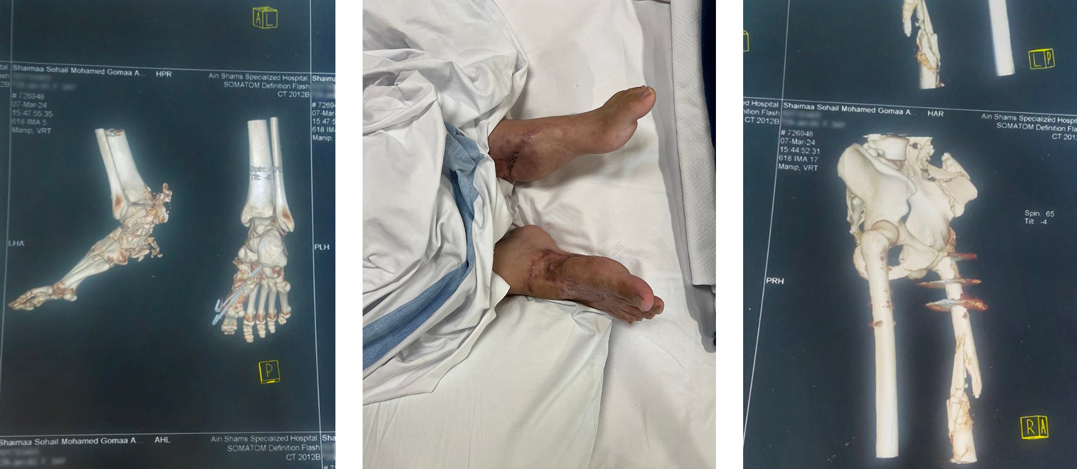 صورة مقطعية لقدمَيْ شيماء أبو جزر بعد الانفجار (يسار)، وقدمَيْ شيماء بعد 47 عملية جراحية، الدوحة، قطر (وسط)، وصورة مقطعية لشظايا معدنية في ساقها بعد الانفجار. 