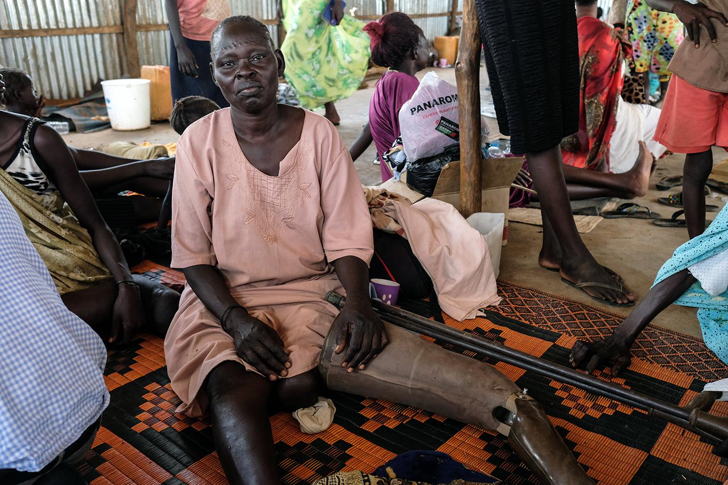 2)	Nyayak Olo Bapit, a Shilluk woman from Malakal, pictured in Juba. She was forced to flee Malakal after a bullet struck her left thigh during fighting there in January 2014.     