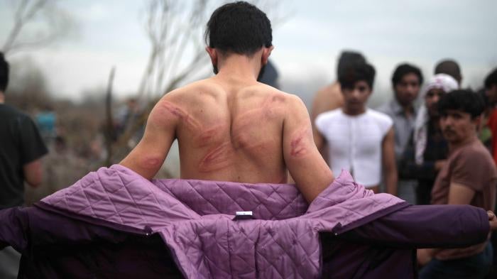 An asylum seeker in northern Turkey at the Greek border on March 6 shows injuries he says Greek security forces inflicted after he had crossed the Evros River into Greece. Photo by Turkish Radio and Television Corporation/Handout/Anadolu Agency.