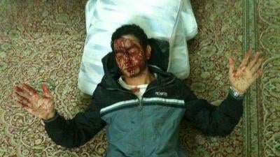 Sayed Ahmed al-Wadaei following his torture in 2011 by the Bahrain security forces.