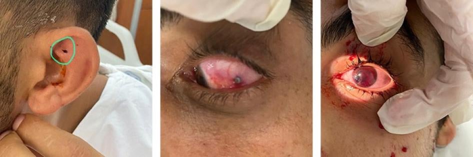 Shotgun-fired metal pellets caused injuries to protesters’ heads and eyes.