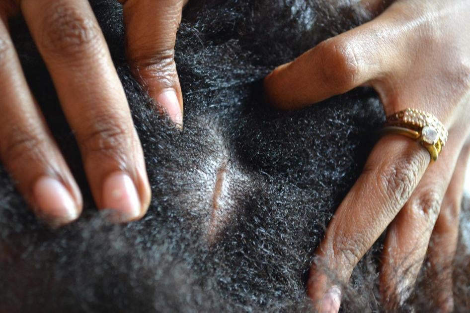 Interpreter uncovering a scar on the head of “Basma N.” Basma said her employer’s son turned on a ceiling fan while she was cleaning the top of a cupboard. The fan hit her head and she fell. 